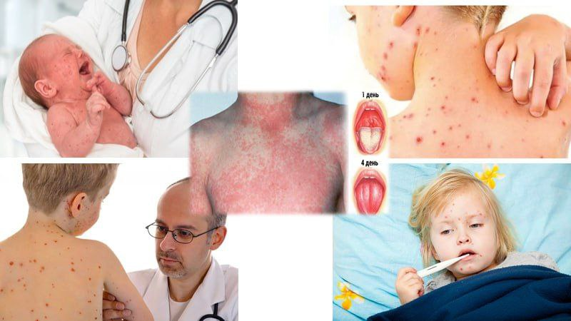 Qizamiq -o'tkir yuqumli kasallik